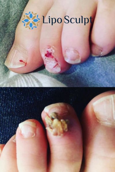 Wart removal customer results from Lipo Sculpt Somerset