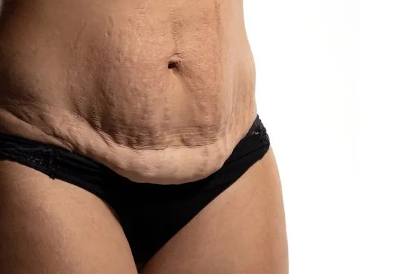 Lost the Weight but Not the Loose Skin? 1 image of womans stomach after weight loss showing loose skin Somerset